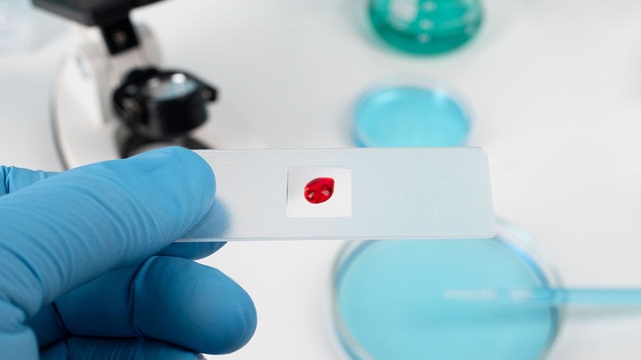 طراحی دستگاه بویایی نوری برای شناسایی زودهنگام سرطان‌های خونی